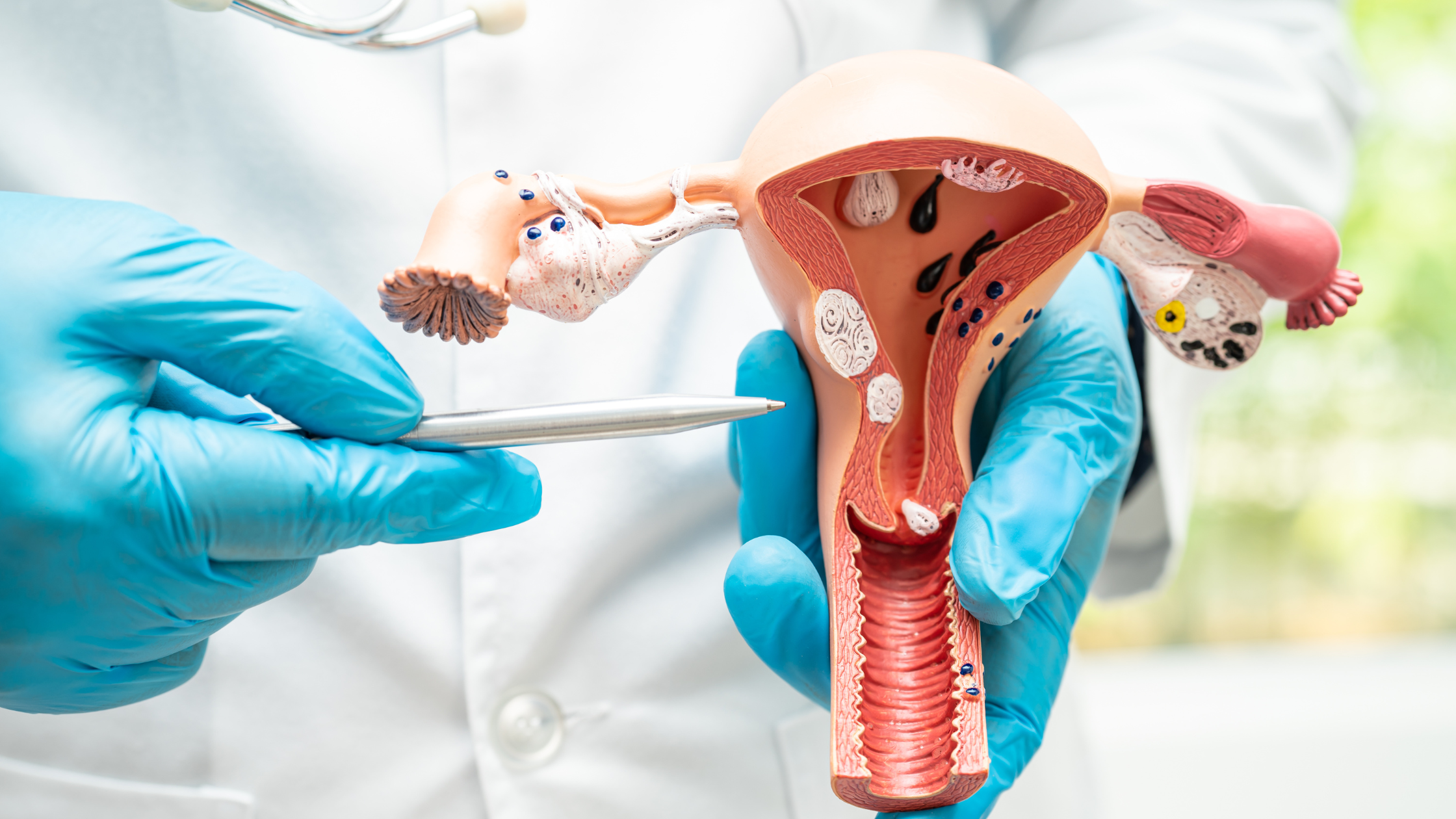 Cervical Cancer Overview