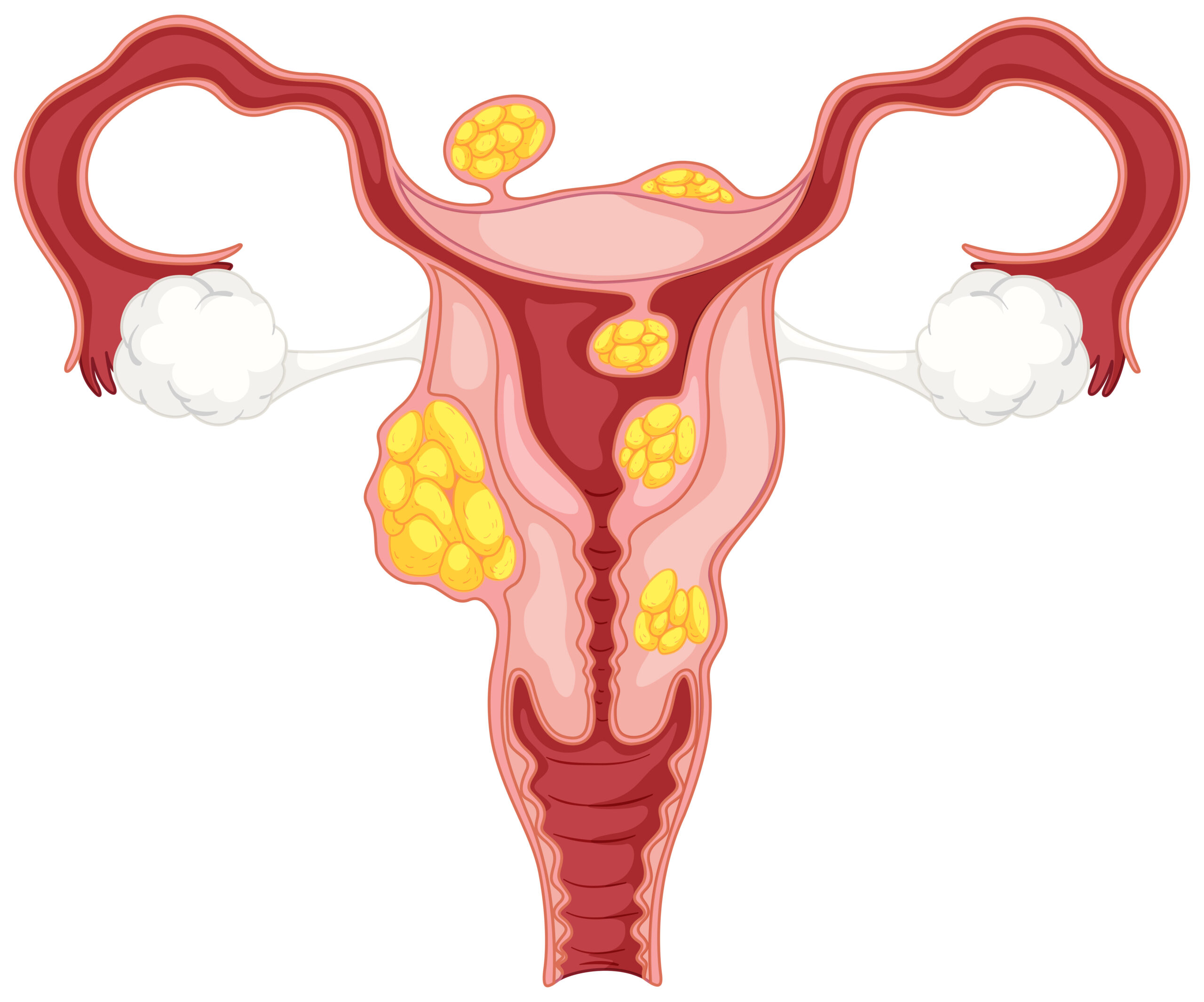 Uterine Fibroids: Causes, Effects, Prevention and Medications